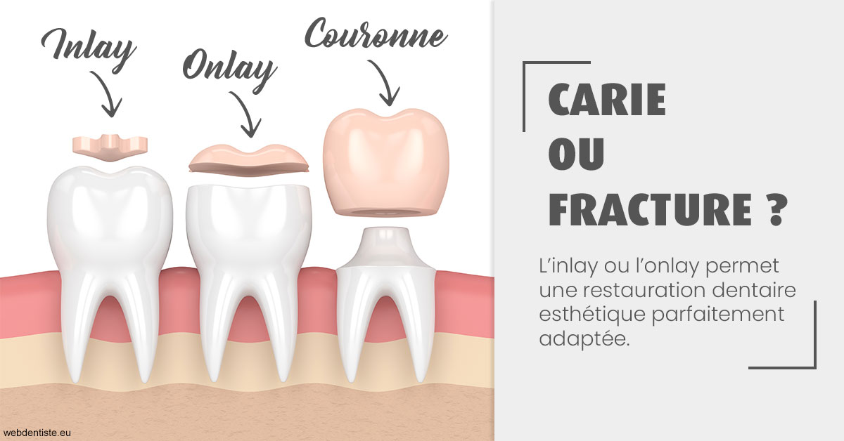 https://selarl-gelos.chirurgiens-dentistes.fr/T2 2023 - Carie ou fracture 1