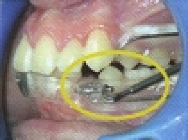Orthodontie fonctionnelle: Insuffisance de croissance mandibulaire : Le P.U.L. (Propulseur Universel Light)