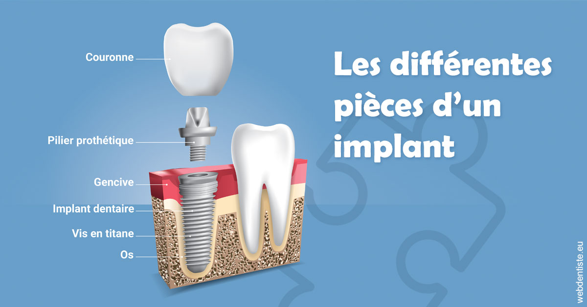 https://selarl-gelos.chirurgiens-dentistes.fr/Les différentes pièces d’un implant 1